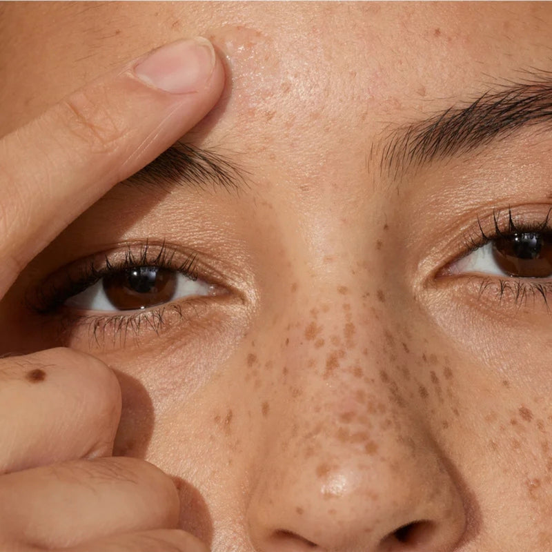 Acne & Onzuiverheden